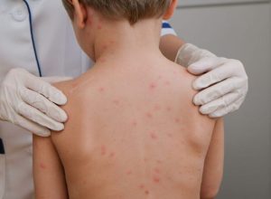 crianc-a-meningite-meningoco-cica